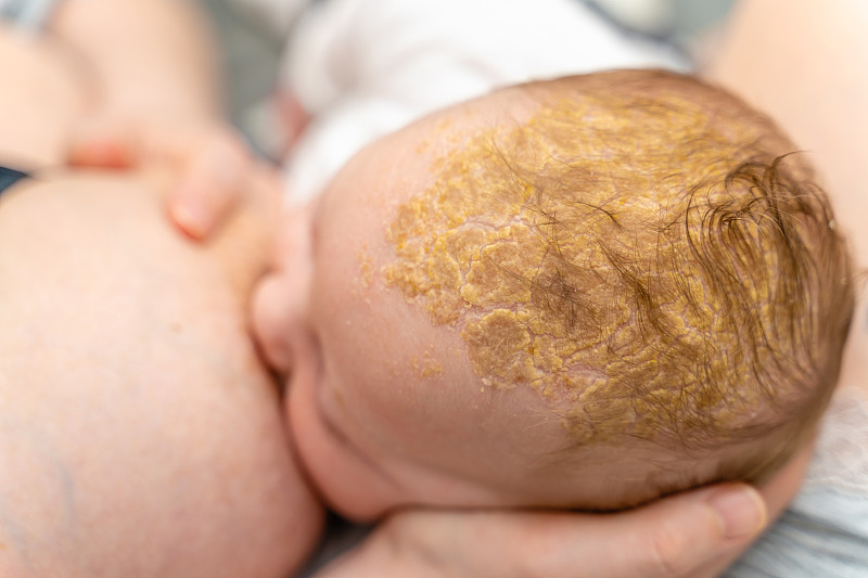 強搖籃帽脂溢性皮炎在嬰兒頭部頭皮哺乳特寫圖片素材