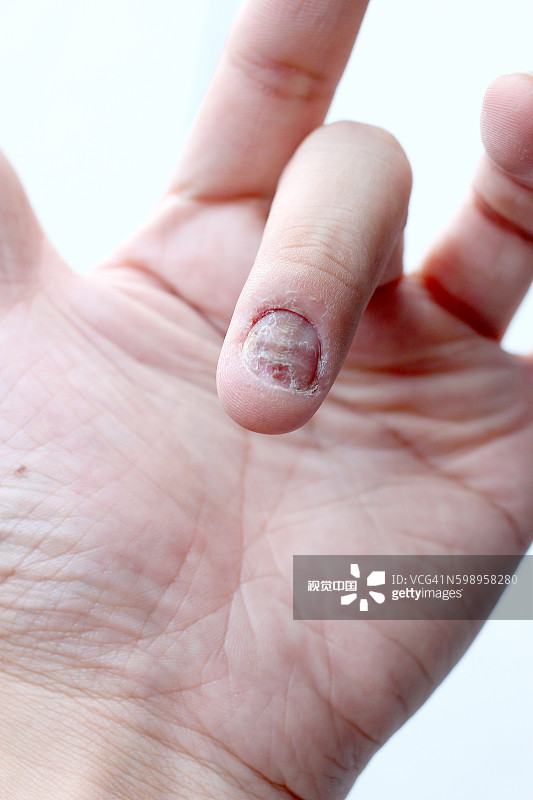 指甲手手指真菌感染及甲真菌病图片素材