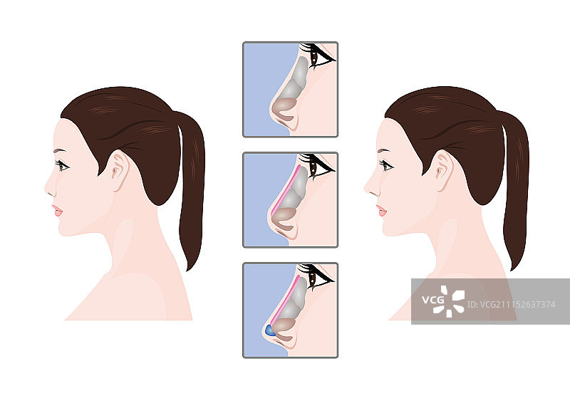 矢量-整容手术的脸和美丽，之前和之后的插图。002图片素材
