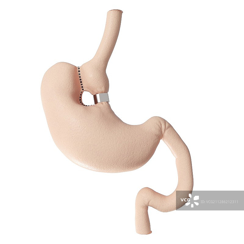 垂直带状胃成形术示意图图片素材