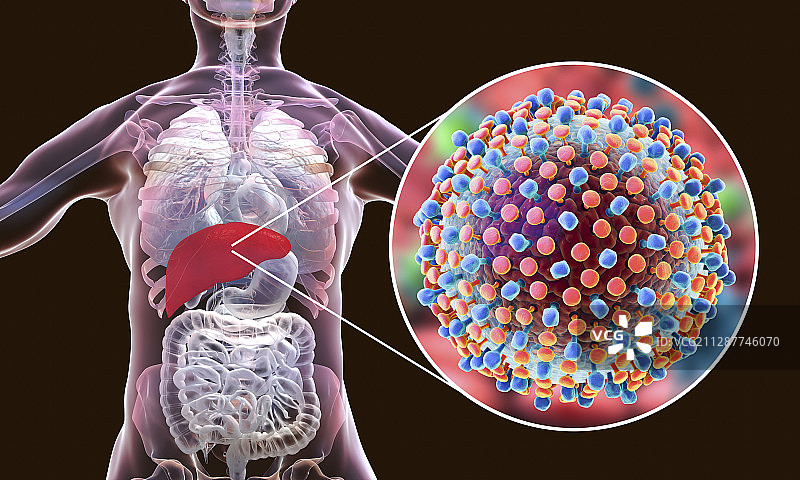 丙型肝炎感染，说明图片素材