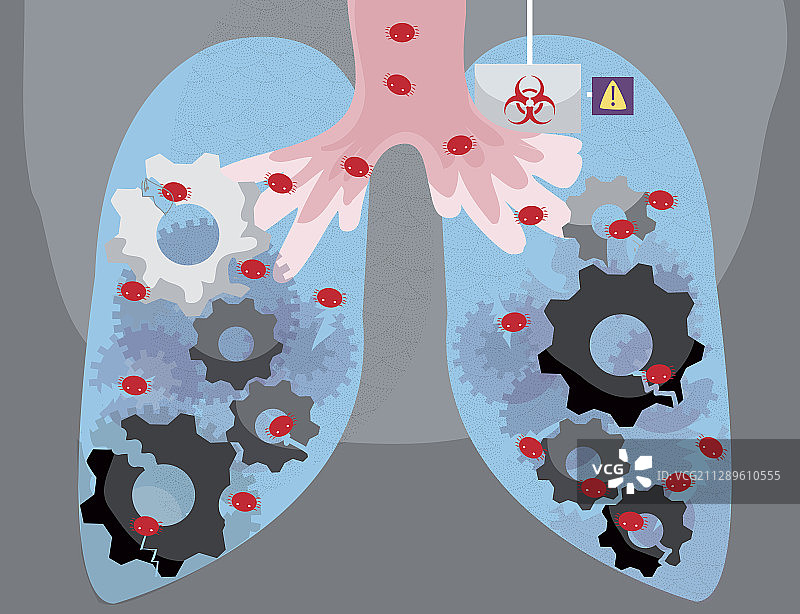 人类肺部被病毒感染的说明图片素材