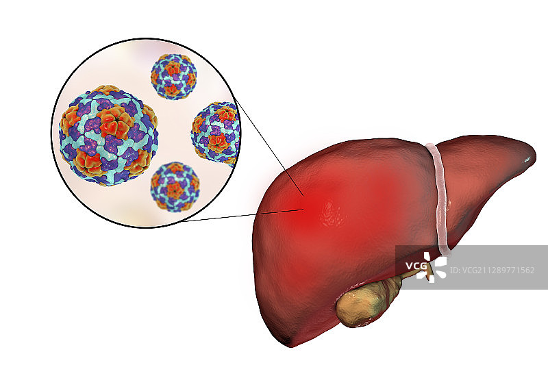 甲型肝炎、插图图片素材