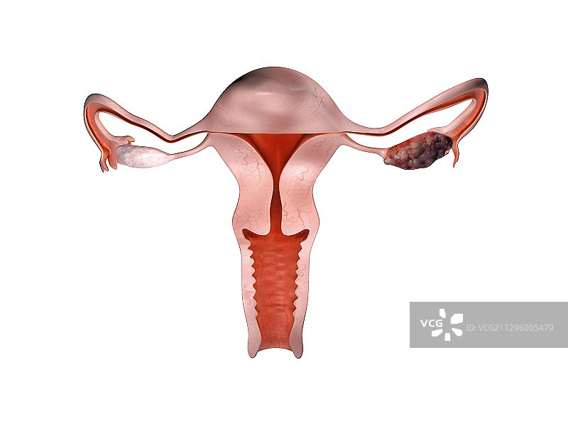 卵巢癌、插图图片素材