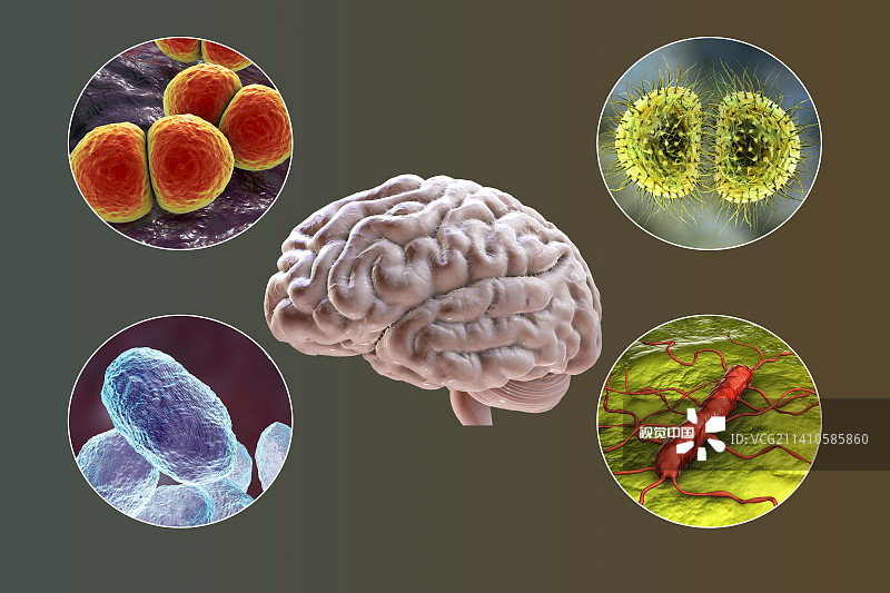 细菌性脑膜炎的原因，插图图片素材