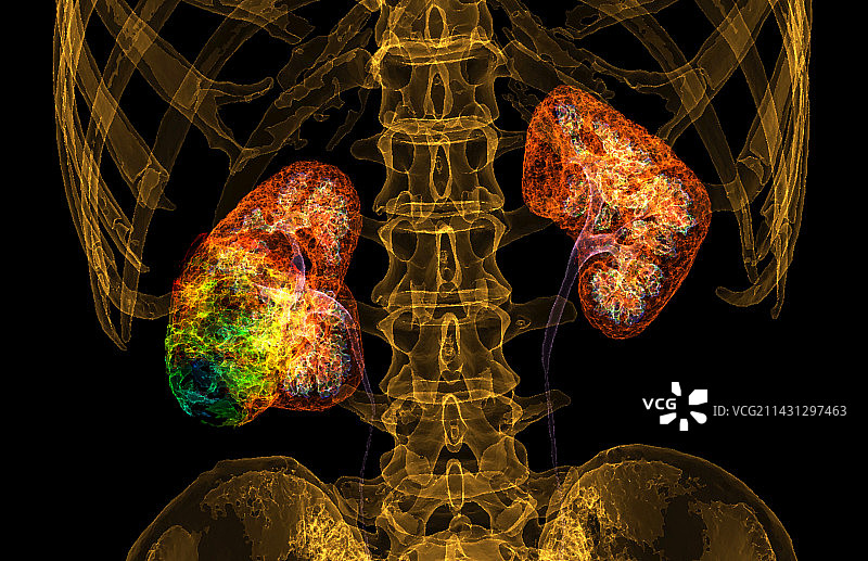 肾癌，3D CT扫描图片素材