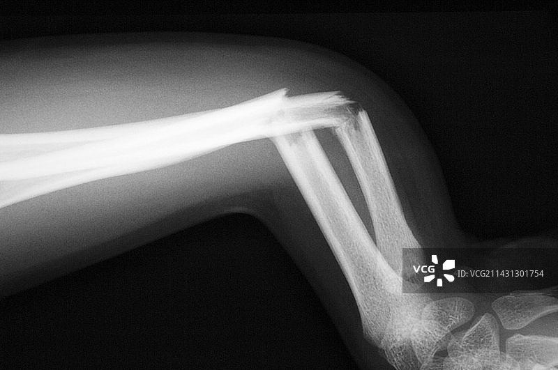 手臂骨折，x光检查图片素材