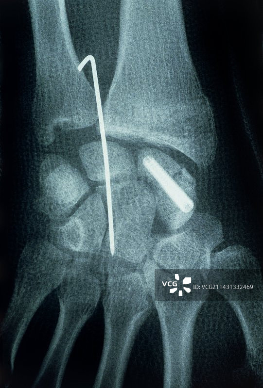 手腕骨折的x光片图片素材