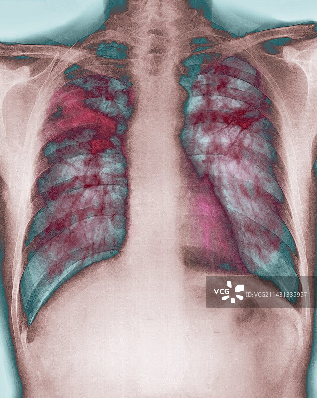 肺纤维化，x光检查图片素材