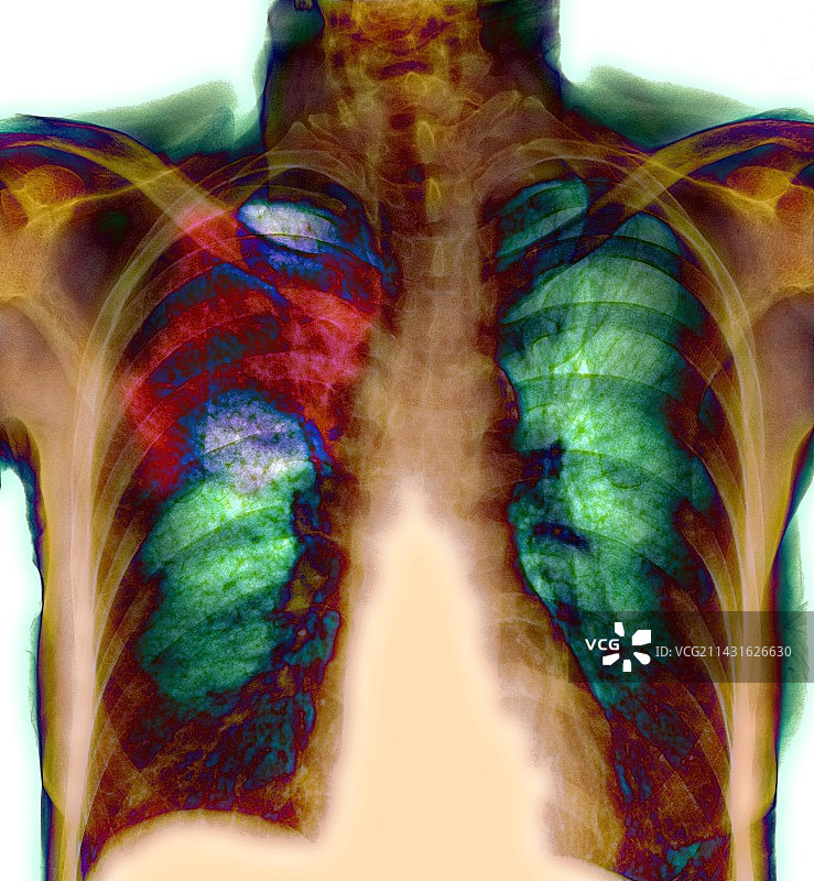 肺炎、x射线图片素材