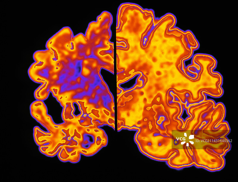 阿尔茨海默病大脑与正常大脑的对比图片素材