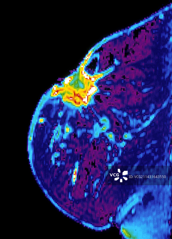 乳腺癌，MRI扫描图片素材