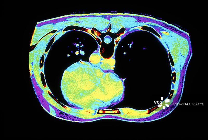 胸部彩色CT扫描显示心脏和肺图片素材