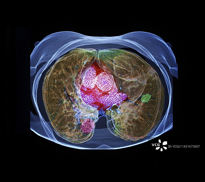 肺癌，CT扫描图片素材
