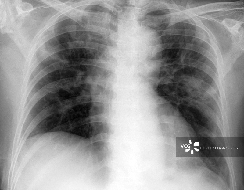 Covid-19肺炎，x光图片素材