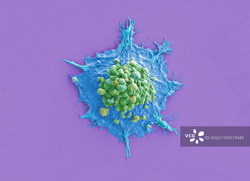 肺癌细胞，扫描电镜图片素材