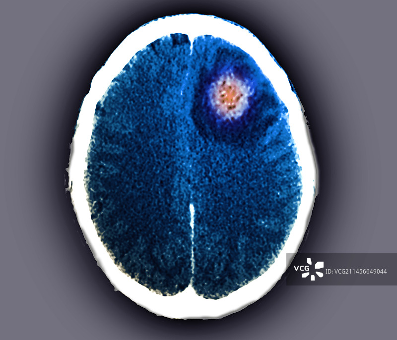 脑脓肿，CT扫描图片素材