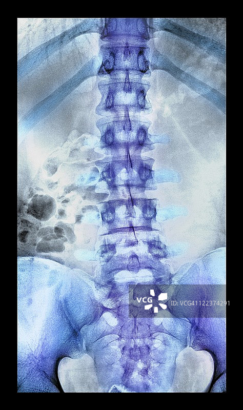 正常的脊柱,x射线图片素材