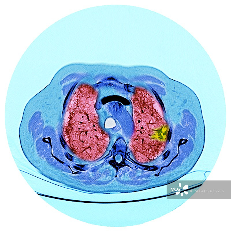 肺癌，CT扫描图片素材