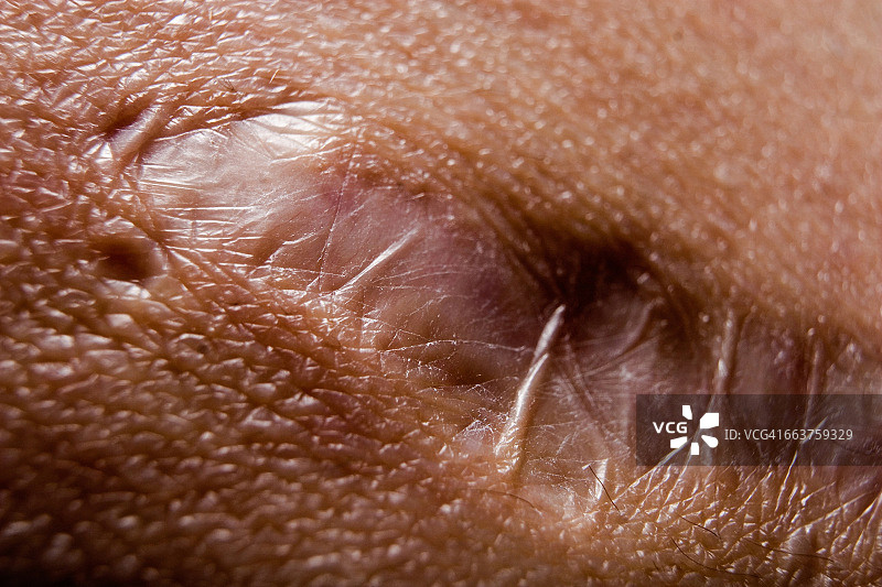 一个人皮肤上的疤痕的特写图片素材