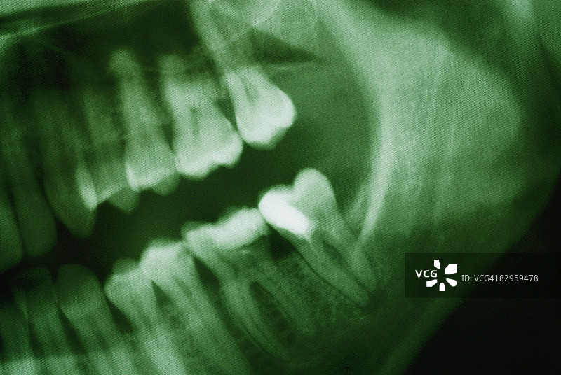 牙科x光的特写图片素材