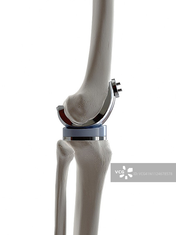膝关节置换术的插图图片素材