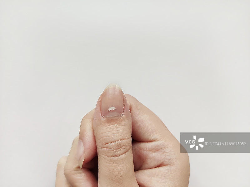 指甲上的白色斑点孤立在白色背景上。疾病leuconychia图片素材