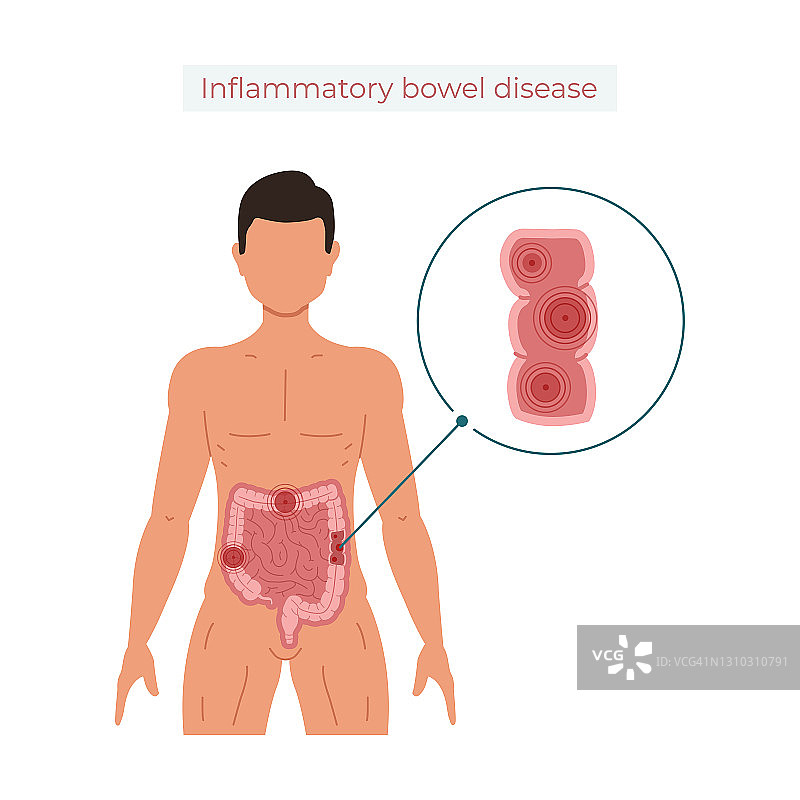 白色背景上分离的炎症性肠病载体插图图片素材