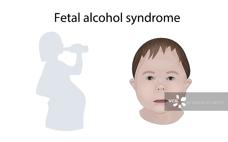 胎儿酒精综合症，说明图片素材