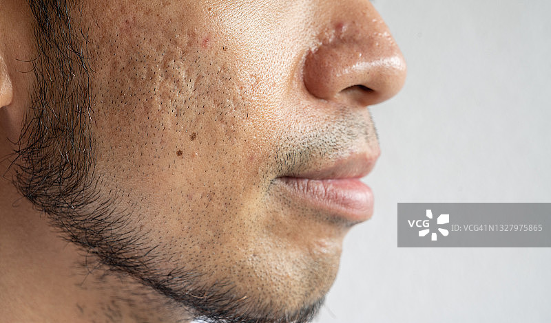 亚洲男性面部毛发生长的侧面图。图片素材