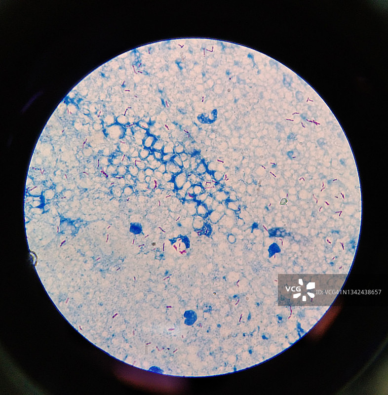 痰涂片AFB染色显微镜下100x显示大量结核大杆菌。图片素材