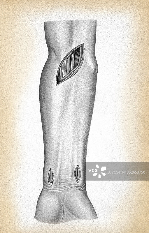 旧彩色印刷插图的外科手术，暴露的手臂动脉图片素材