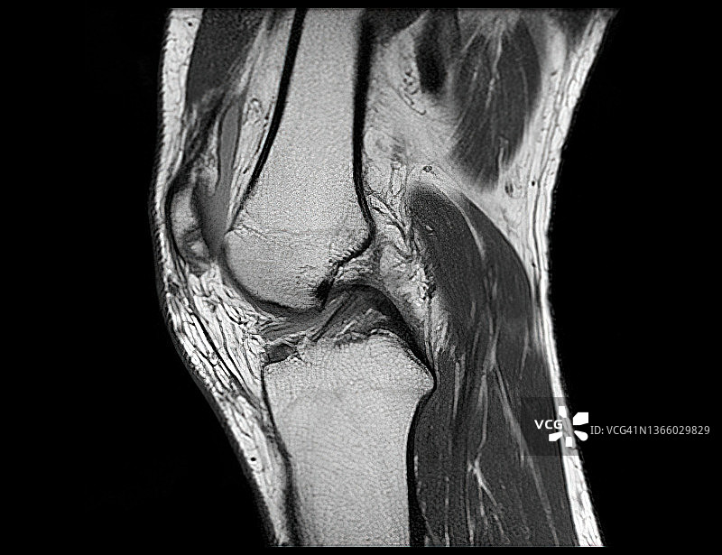 磁共振成像膝关节磁共振成像。图片素材