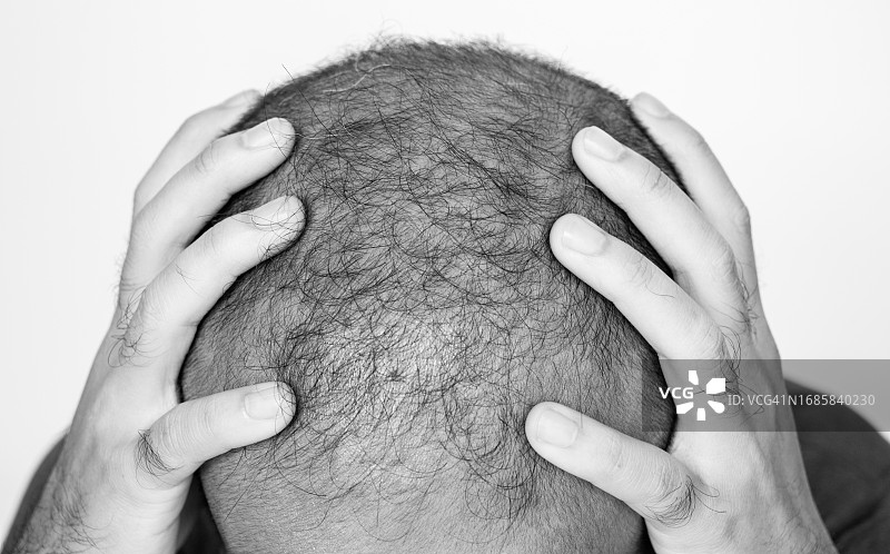 男性有压力导致秃顶问题。秃顶与你的基因和男性性激素有关。图片素材