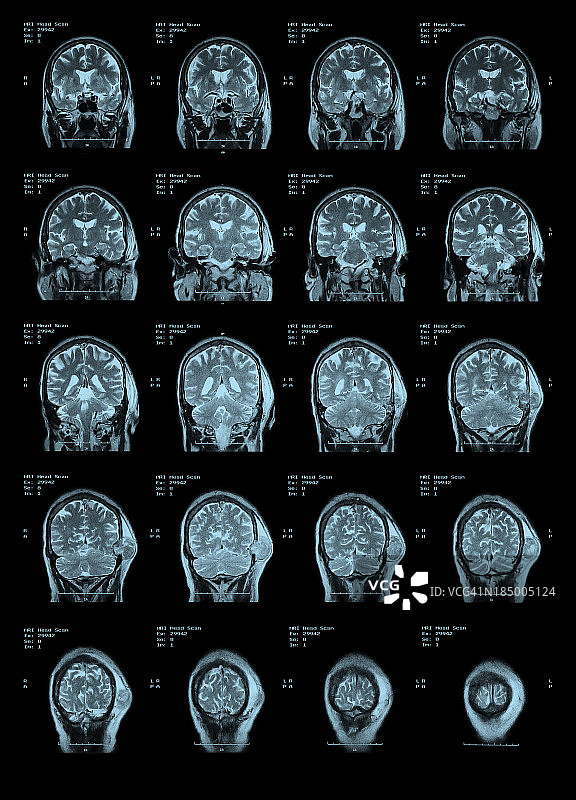 MRI头部扫描后视图。图片素材