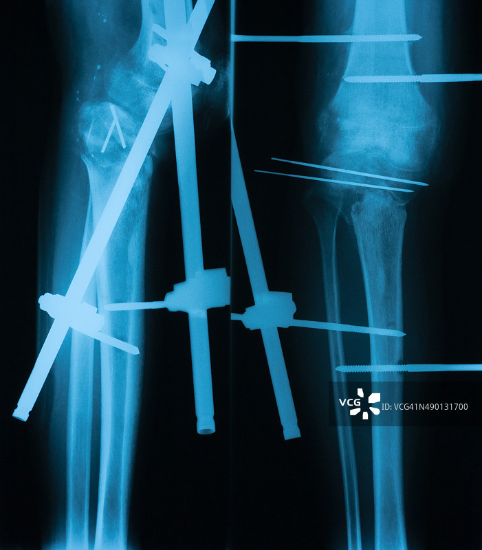 膝关节脱位及胫骨骨折x线照片图片素材