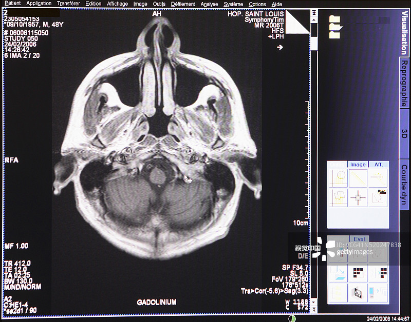 大脑的核磁共振扫描图片素材