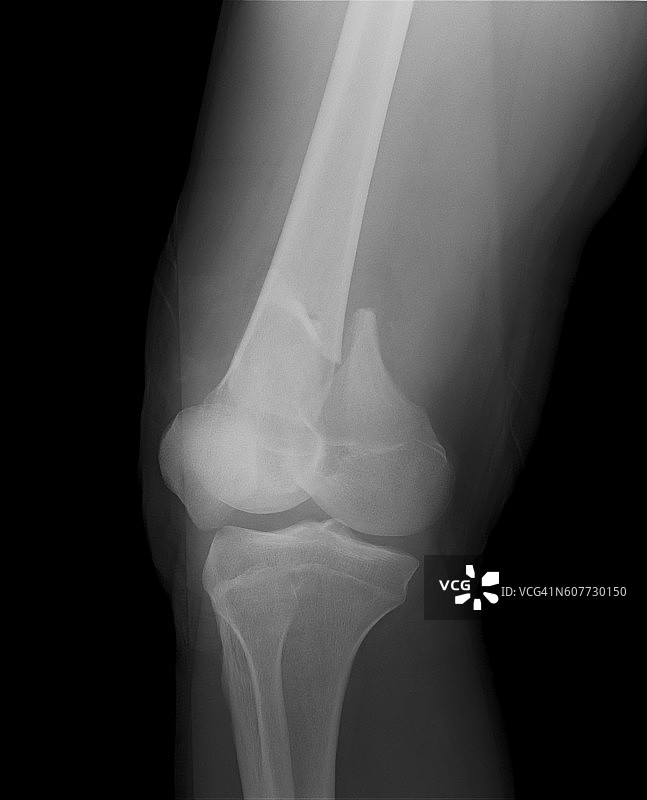 膝关节正位x光片显示股骨远端骨折图片素材