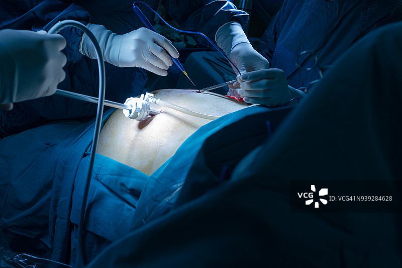 使用腹腔镜设备进行手术图片素材