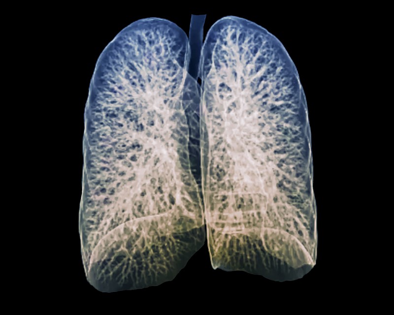 肺部健康CT扫描图片下载