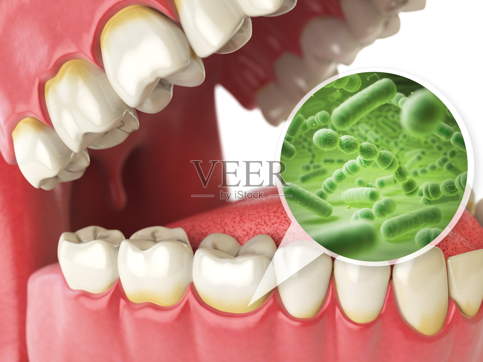 牙齿周围有细菌和病毒。牙科卫生医学概念。插画图片素材
