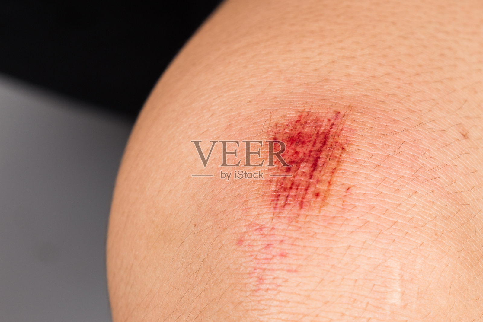 膝盖上有新鲜的流血瘀伤照片摄影图片