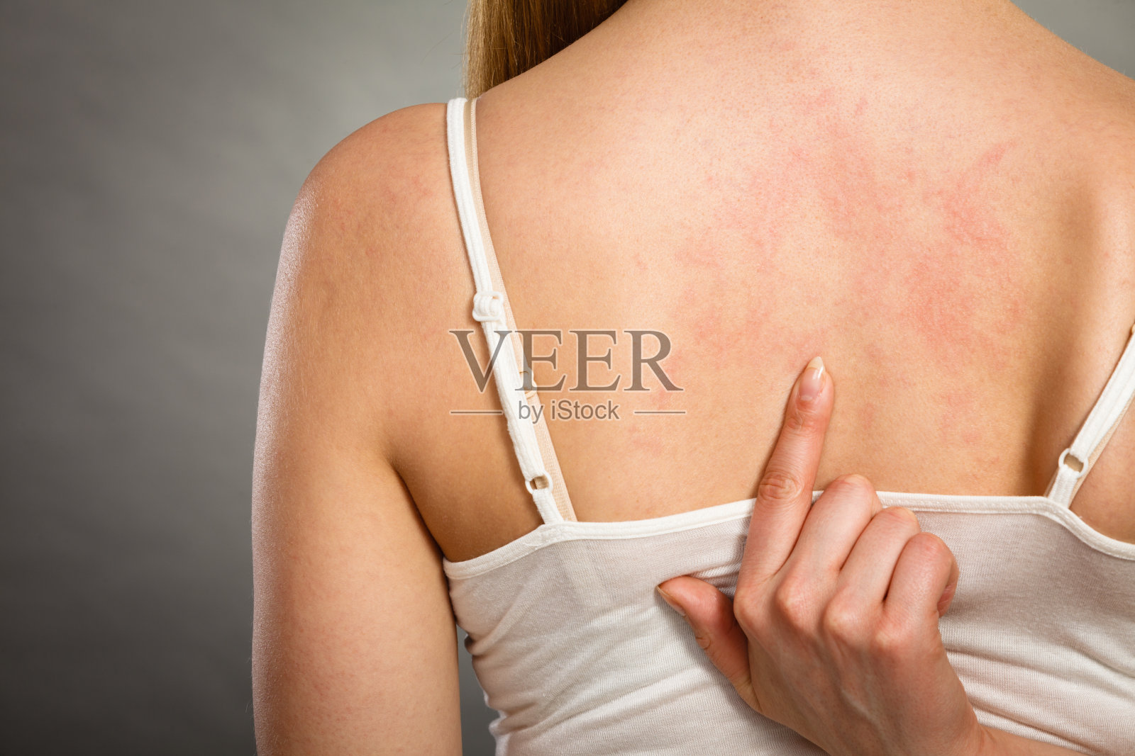 一个女人用过敏皮疹挠着她发痒的后背照片摄影图片