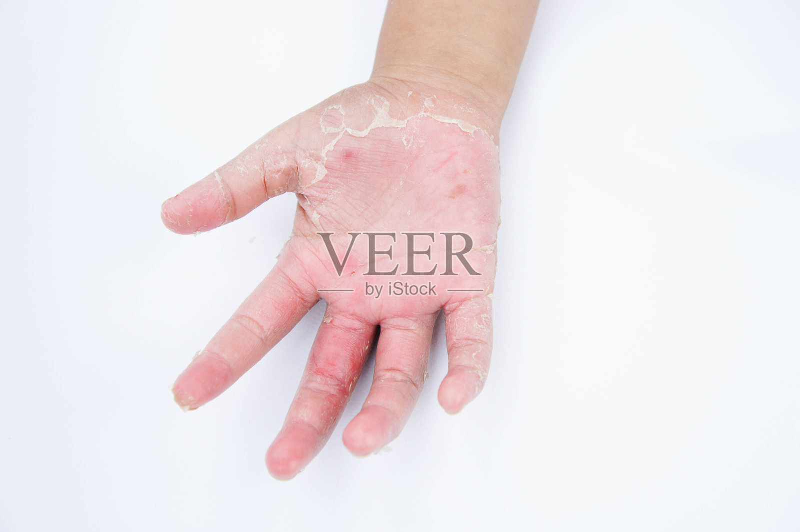 手干燥，脱皮，接触性皮炎，真菌感染，皮肤炎症照片摄影图片