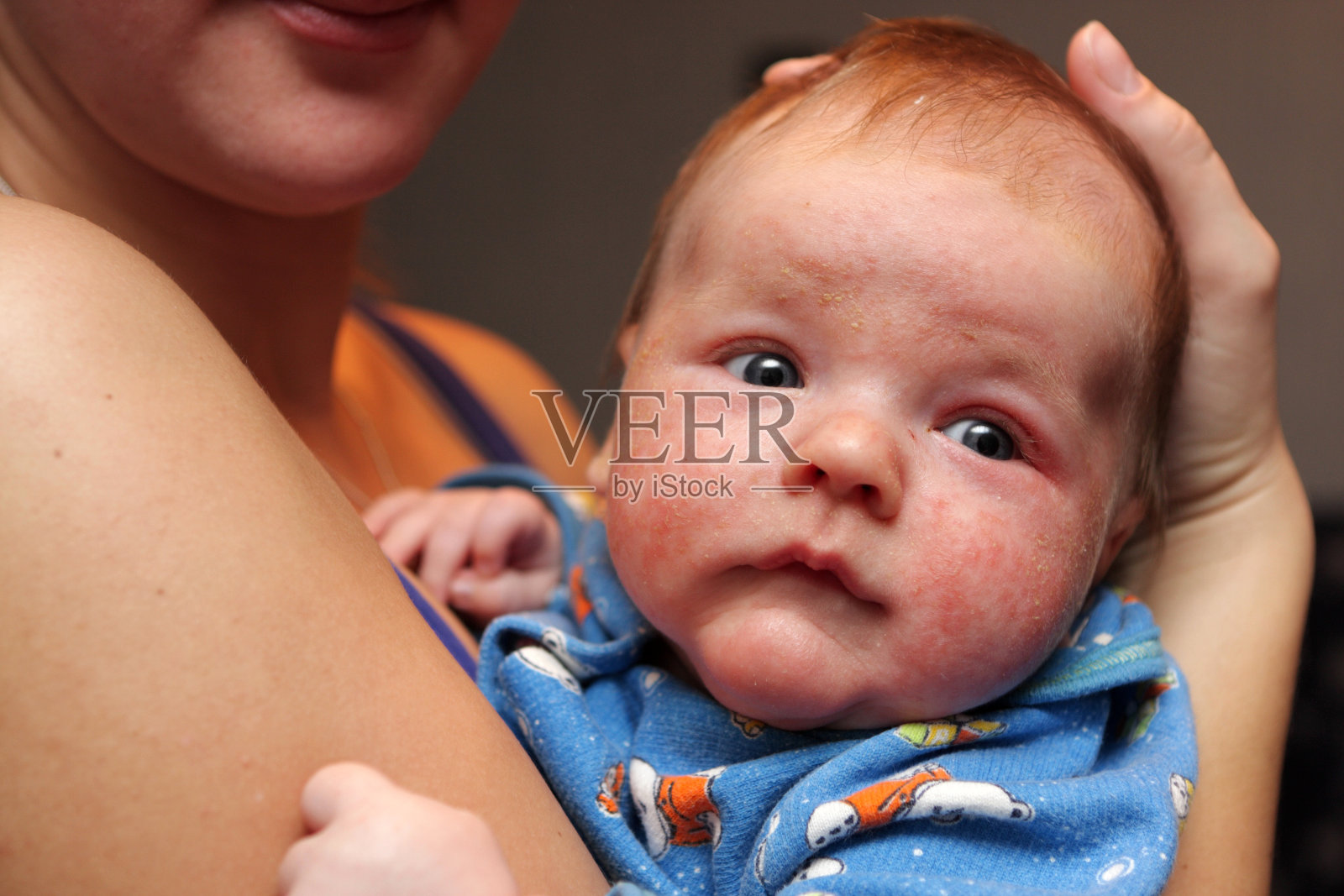 婴儿脸上有湿疹照片摄影图片