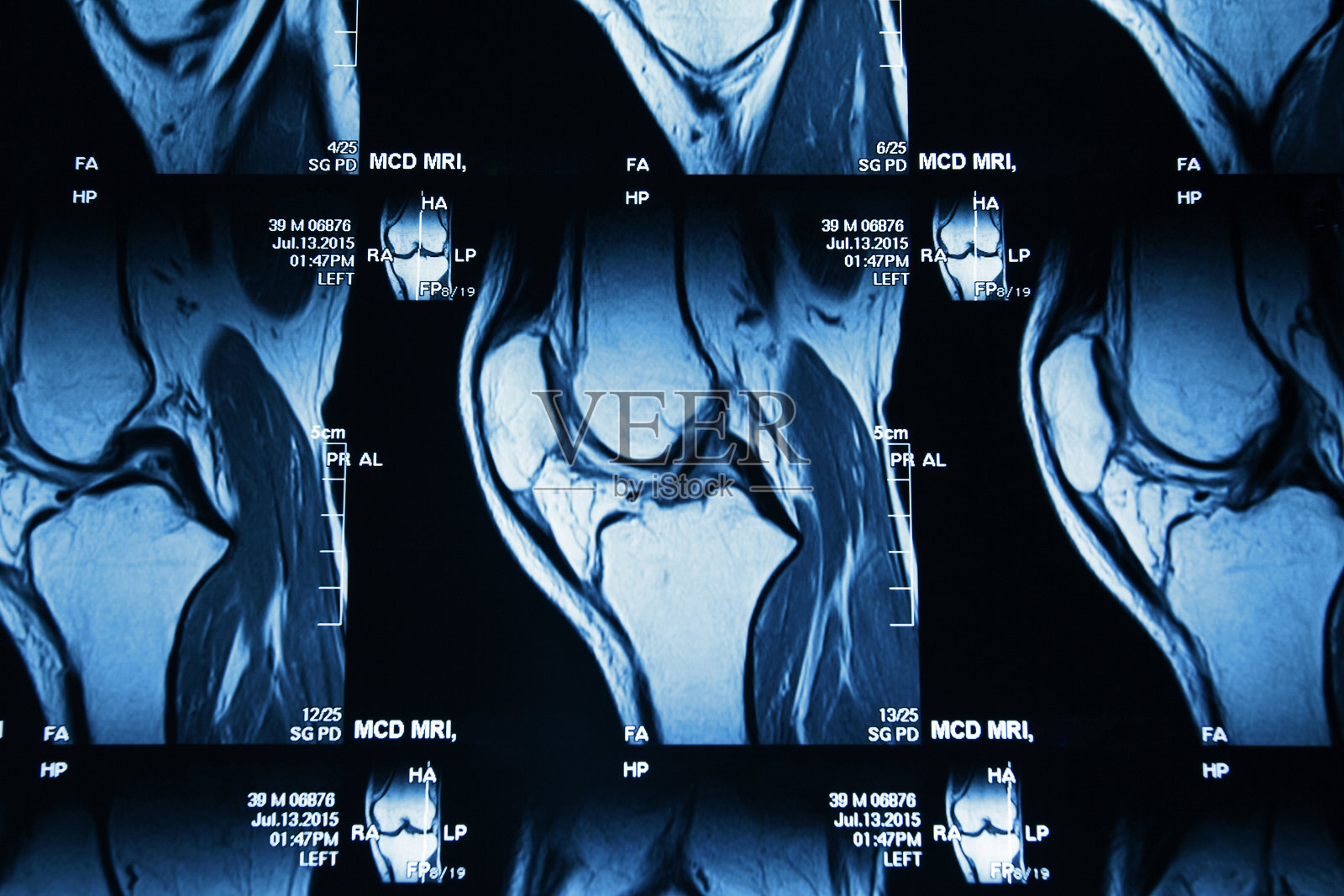 膝关节MRI图像照片摄影图片