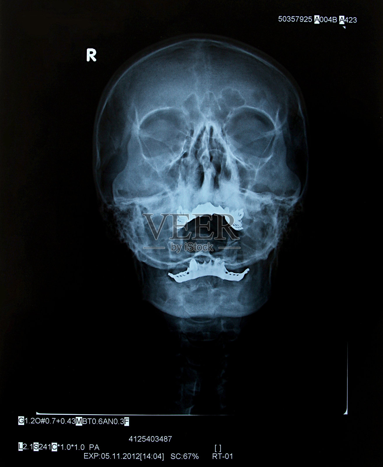 人类头骨x光照片摄影图片