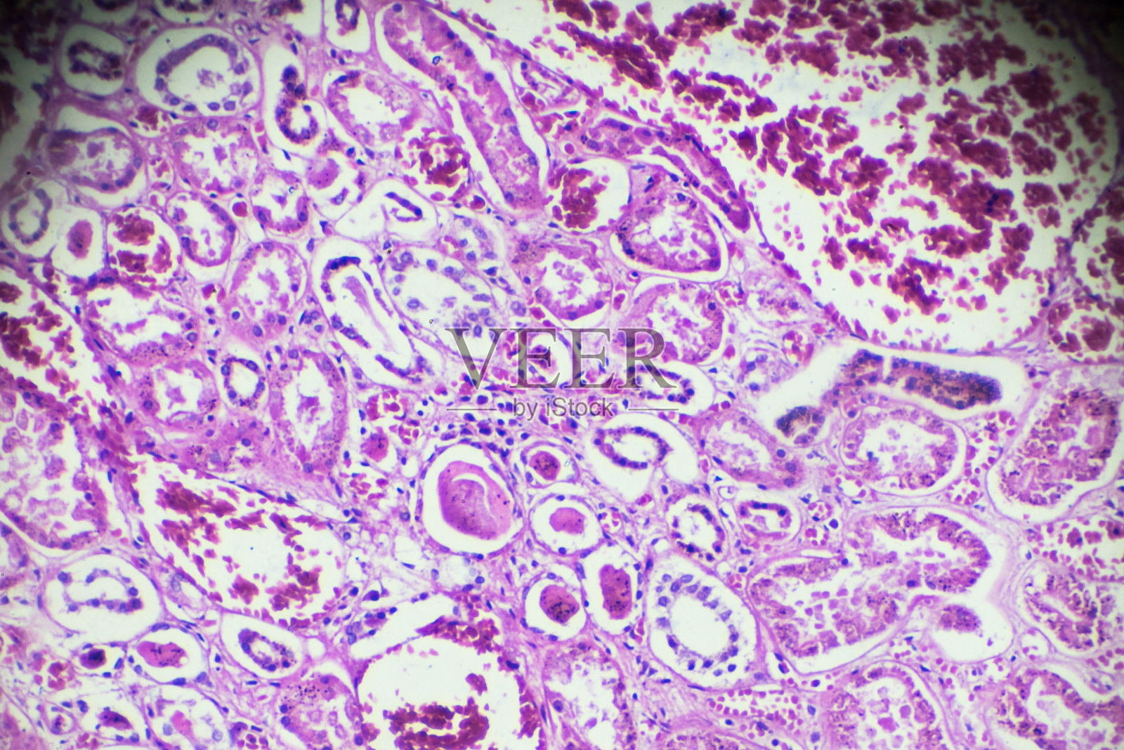 显微镜下急性肾炎活检标本照片摄影图片