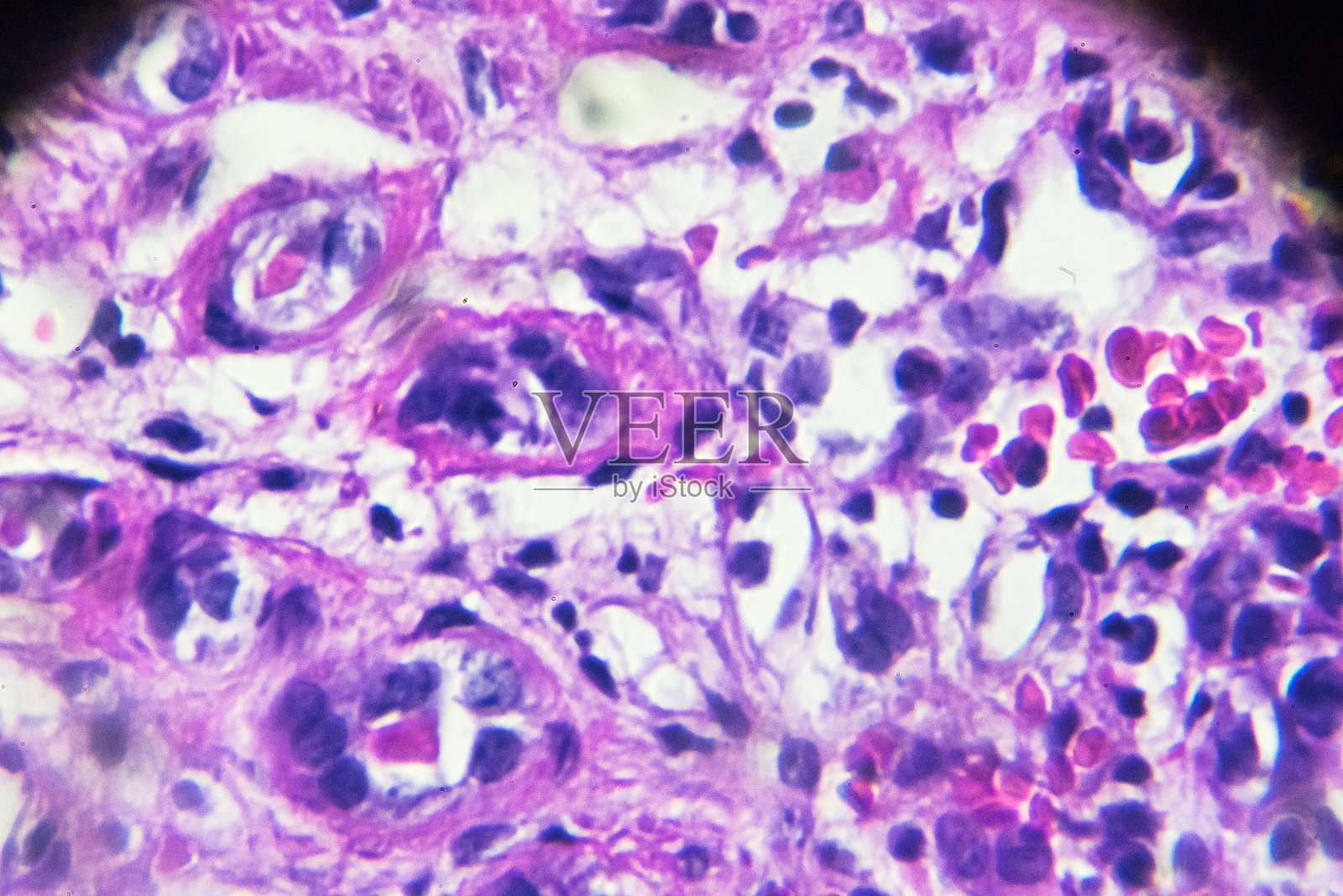 新月体肾小球肾炎活检标本照片摄影图片