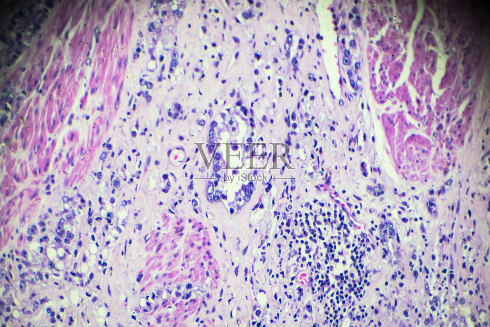 显微镜下前列腺癌活检照片摄影图片